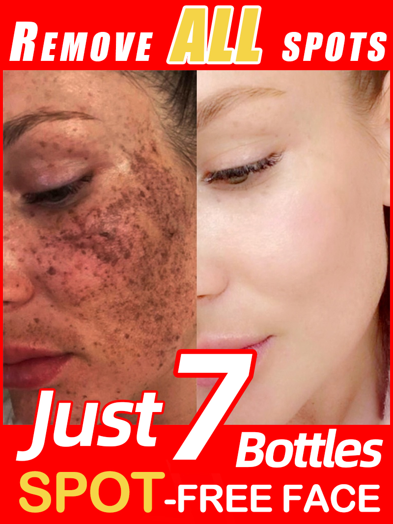 ลดเลือนฝ้า กระ จุดด่างดำบนใบหน - Skincare Luxury Whitening บทวิจารณ์และราคา